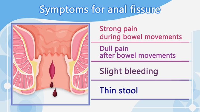 Anal fissures: causes and symptoms