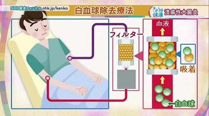 日本で開発された白血球除去療法のイメージ