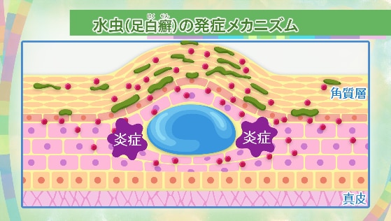 水虫発症のメカニズム。菌が角質層の内部に入り込んでしまうと、白癬菌が角質を食べてしまう