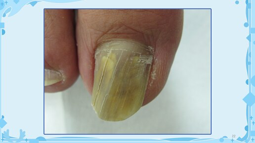爪白癬で黄色に濁っている爪