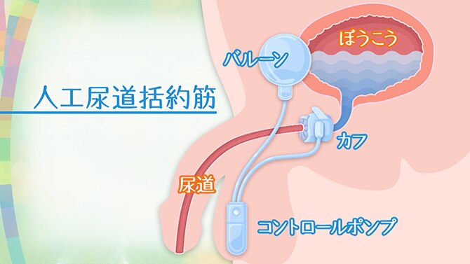 人工尿道括約筋埋め込み術