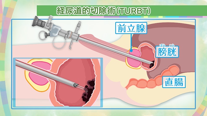 経尿道的切除術（TURBT）