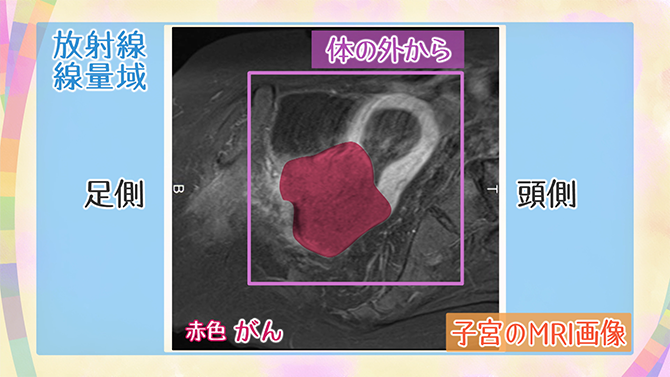 体の外から照射したときの子宮のMRI画像