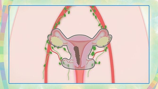 子宮周辺の組織や骨盤の内側にあるリンパ節も切除