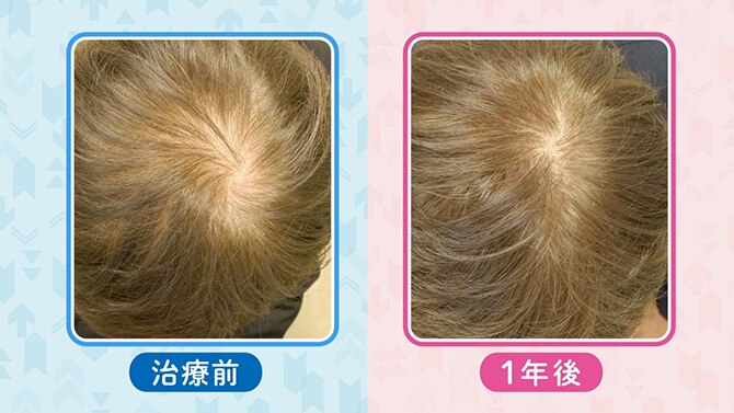 AGAの治療をする前と後での頭頂部の比較