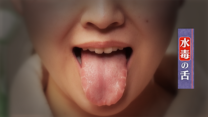 水毒の舌