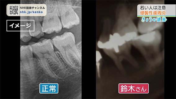 正常な場合と侵襲性歯周炎のエックス検査のイメージ画像