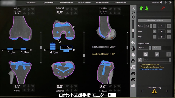 ロボット支援手術 モニター画面