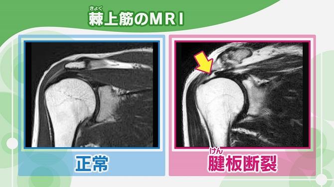 腱板断裂が生じている棘上筋と生じていない棘上筋のMRI画像