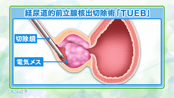 経尿道的前立腺核出切除術「TUEB」