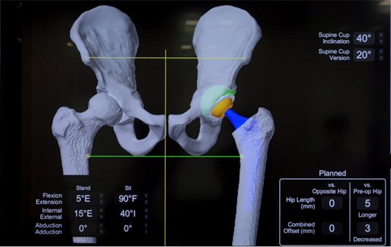 CTで撮影した股関節