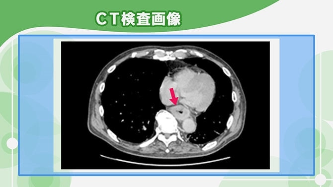 CT検査で見た食道がんの写真