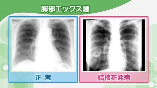 胸部エックス線検査で正常な場合と結核の炎症が写っている写真