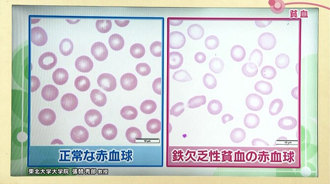 正常な赤血球と鉄欠乏性貧血の赤血球の比較