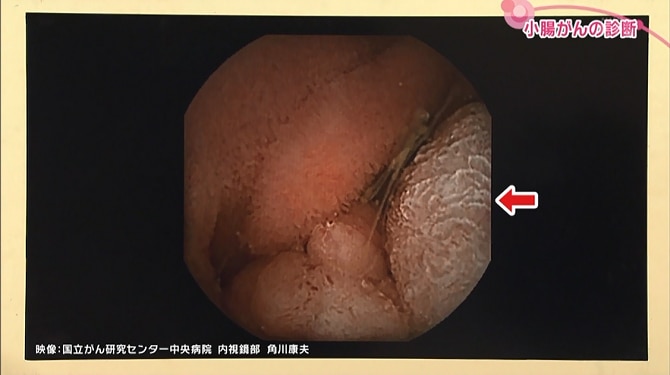 カプセル内視鏡で小腸がんを発見した時の画像