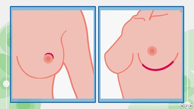 乳房温存手術