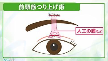 眼瞼下垂の手術　前頭筋つり上げ術