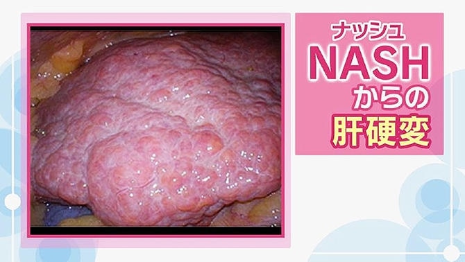 NASHの原因や治療法　肝がんへ進行する恐れあり