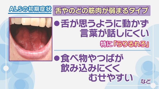 ALSの初期症状（舌やのどの筋肉が弱まるタイプ）