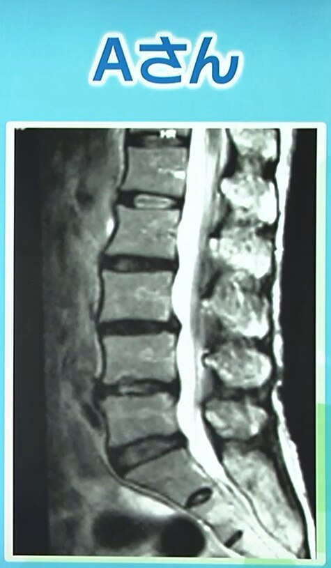 慢性腰痛 MRI画像