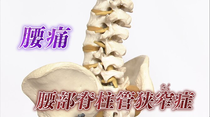 腰部脊柱管狭窄症　タイプ・薬・お勧めの運動・最新手術