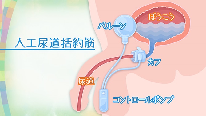 男性の尿もれ治療「人工尿道括約筋埋め込み術」で排尿をコントロール