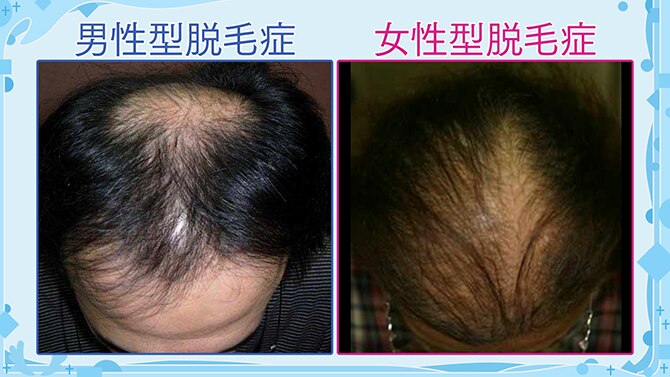 薄毛（AGA・女性型脱毛症）の悩み 治療法とガイドラインによる推奨度