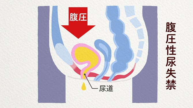 【患者体験談】腹圧性尿失禁を手術で治療