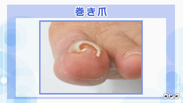 巻き爪の原因と治療法とは？巻き爪を予防する正しい歩き方も解説
