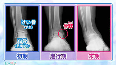 足首の痛み　主な原因である変形性足関節症の症状と治療法