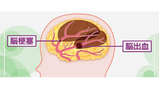 脳の血流が悪くなることで起こる血管性認知症 症状や原因、検査について