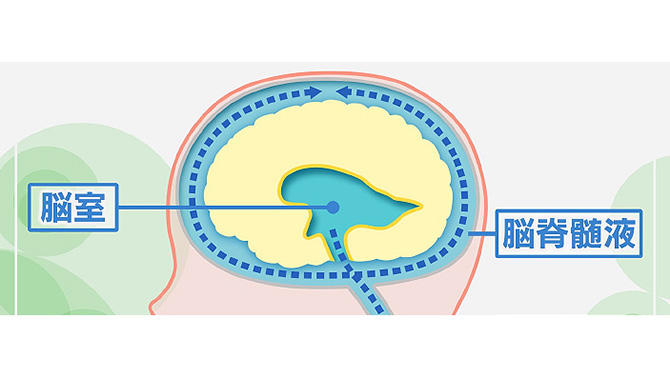 脳を保護する髄液が増加しさまざまな症状を招く正常圧水頭症とは