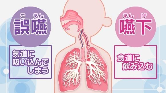 高齢者に多い肺炎「誤えん性肺炎」原因、症状と日常生活でできる予防