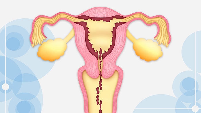 激しい生理痛を引き起こす子宮内膜症 原因や症状、セルフチェック