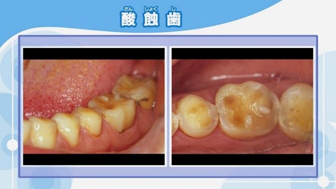 歯が溶ける酸蝕歯（さんしょくし）の原因と治療法、セルフケアとは