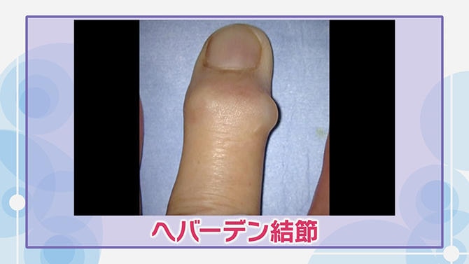 手指に腫れ・痛み・変形が起こる「変形性指関節症」 症状と治療・予防法