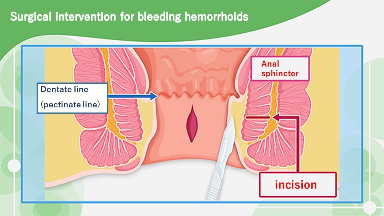 Hemorrhoids：Different type, cause, treatments and surgery intervention.