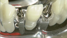 歯科インプラント　トラブル急増の理由