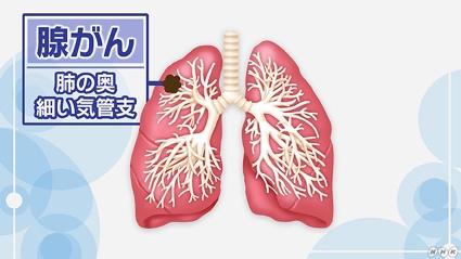 肺がんの約60％を占めるのが腺がん