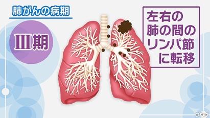 肺がんの病期