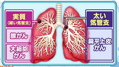 肺がんの4つの種類(腺がん、小細胞がん、大細胞がん、扁平上皮がん)
