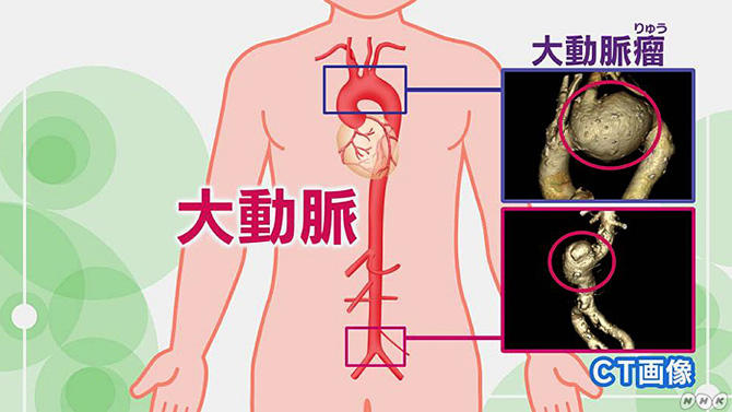 NHK健康チャンネルで確かな医療・健康情報を破裂すると命の危険もある大動脈瘤（だいどうみゃくりゅう）とは