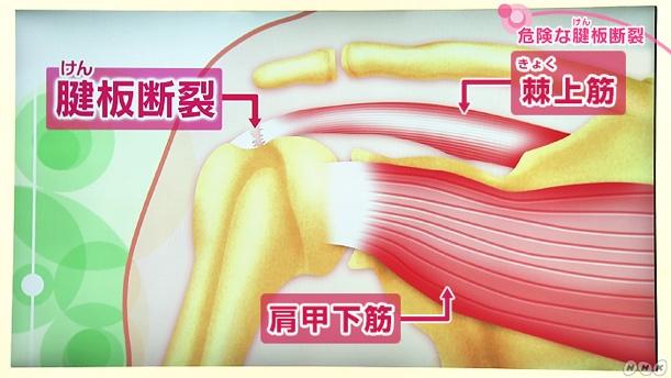 肩・上腕が痛い！加齢によって腱板が切れてしまう腱板断裂とは | NHK健康チャンネル