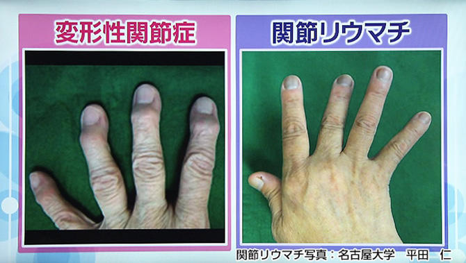 変形性関節症と関節リウマチの患者の手の写真