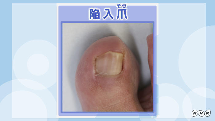 巻き爪の原因と治療法とは？巻き爪を予防する正しい歩き方も解説 | NHK健康チャンネル