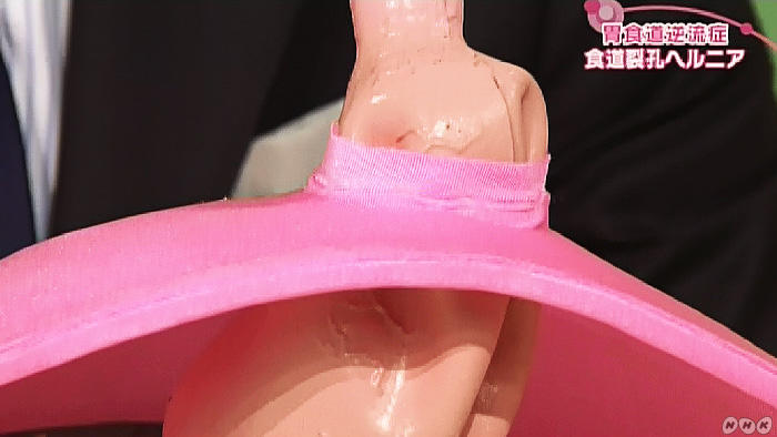 食道裂孔ヘルニアの模型イメージ
