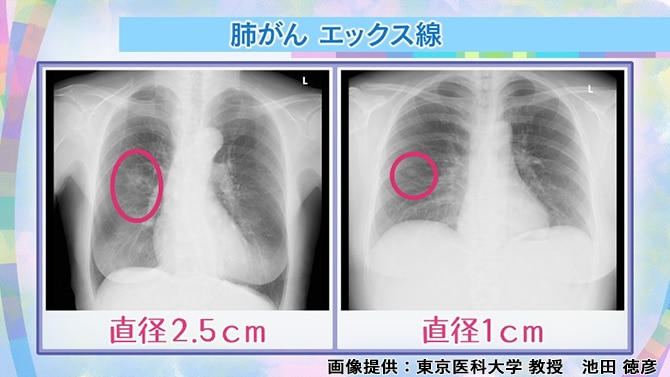 肺がん エックス線の画像