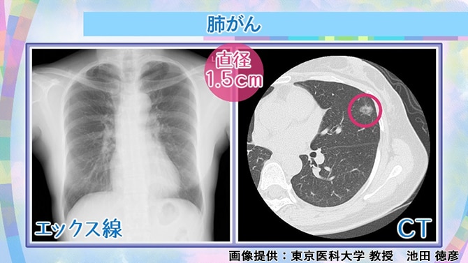 エックス線検査とCT検査でみたときの直径1.5cmの肺がん