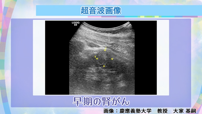 腎がんの超音波検査の写真