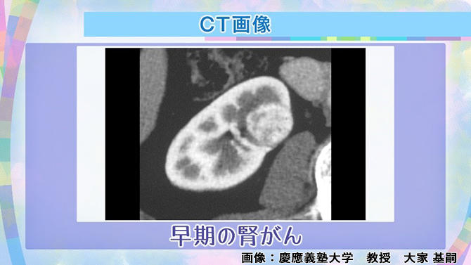 早期の腎がんのCT画像